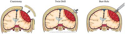 Surgical techniques for evacuation of chronic subdural hematoma: a mini-review